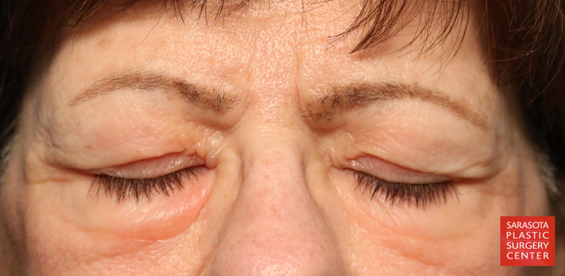 Blepharoplasty: Patient 15 - Before 2