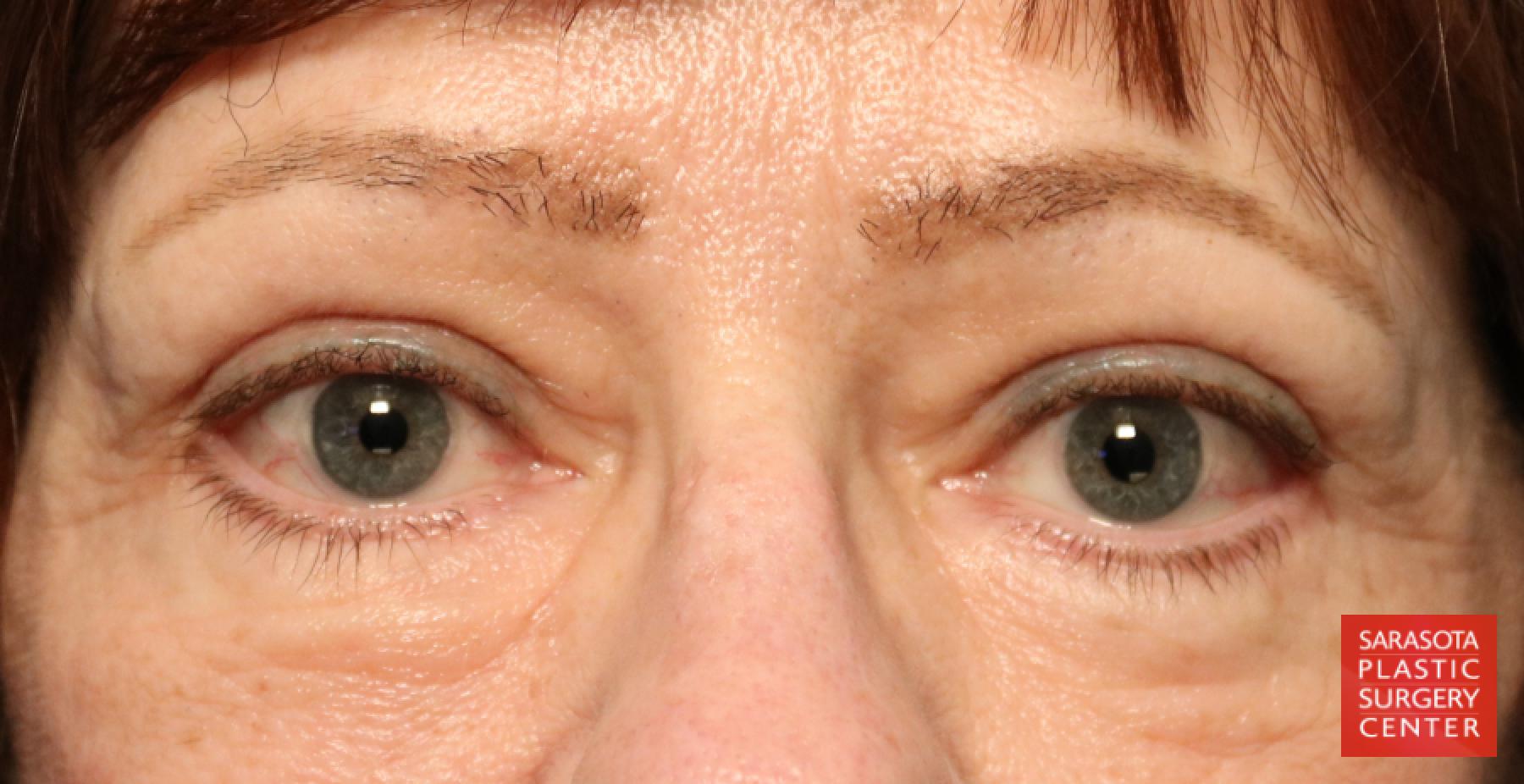 Blepharoplasty: Patient 15 - After 