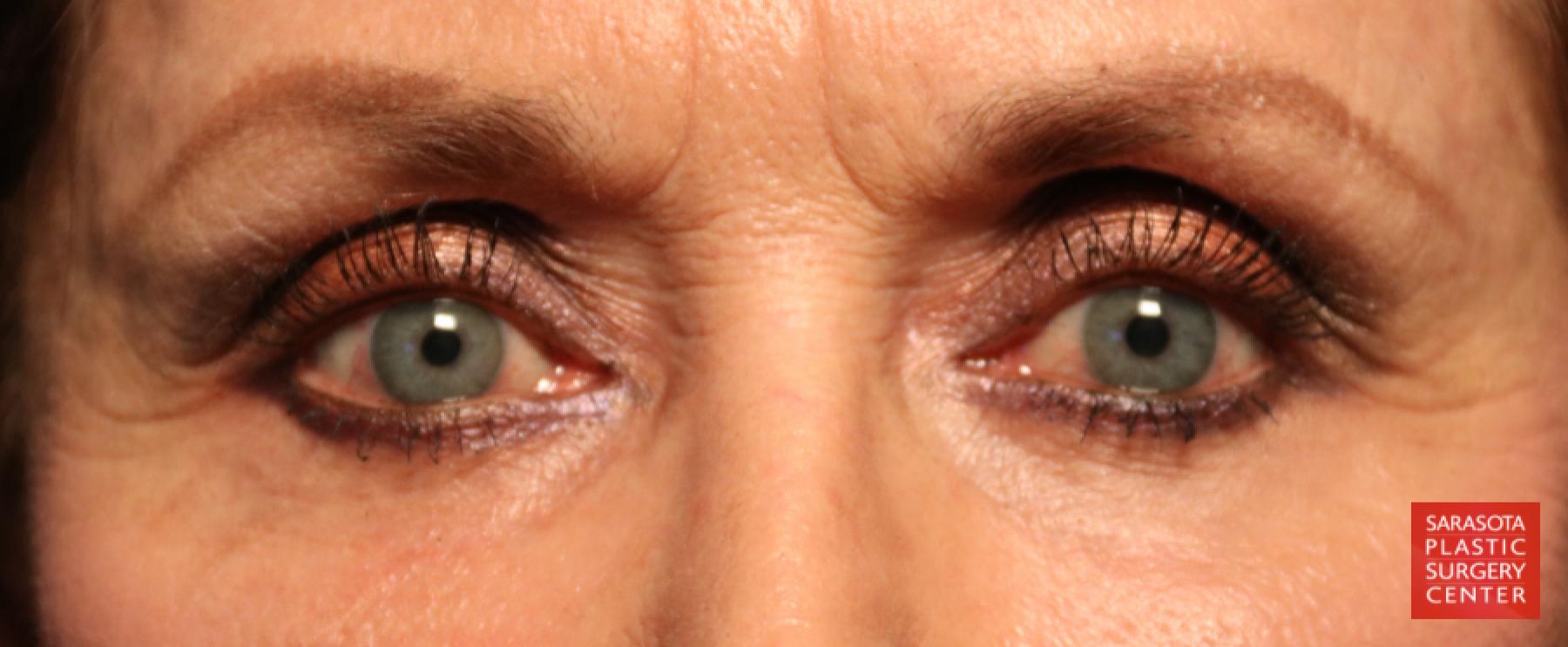 Blepharoplasty: Patient 20 - After 