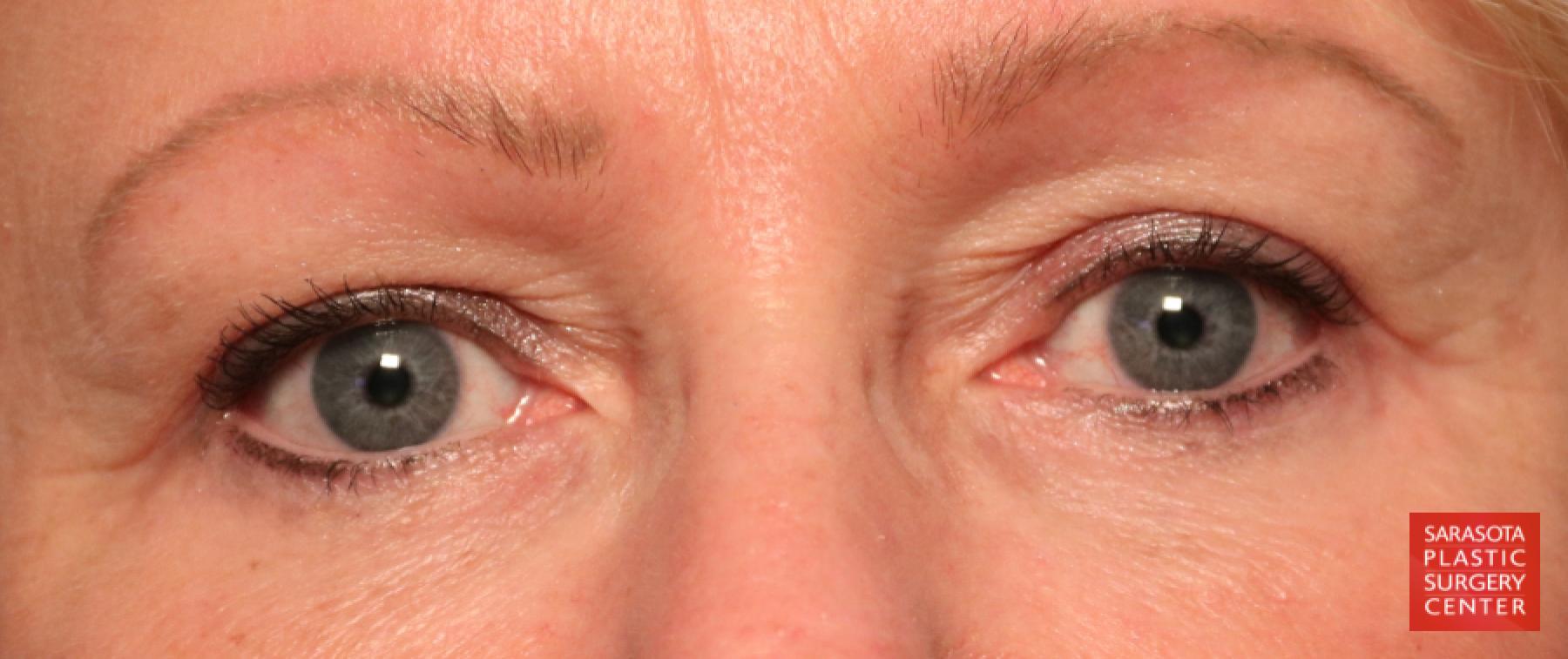 Blepharoplasty: Patient 24 - After 