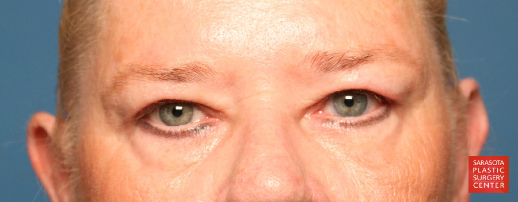 Blepharoplasty: Patient 29 - After 