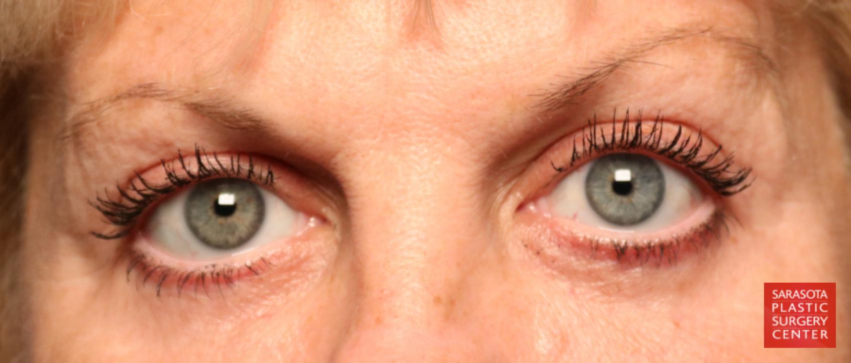 Blepharoplasty: Patient 19 - After 