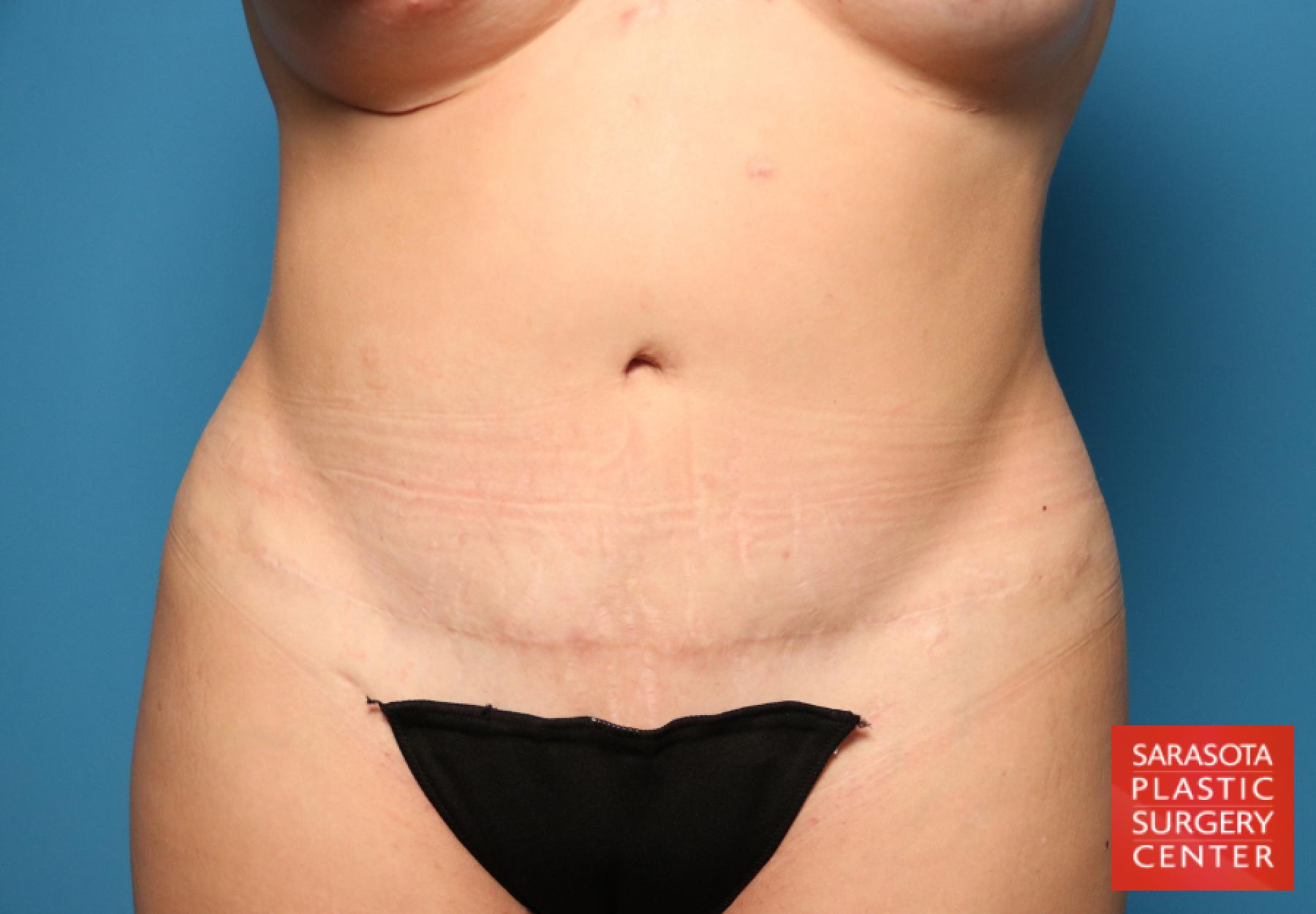 Tummy Tuck: Patient 40 - After 
