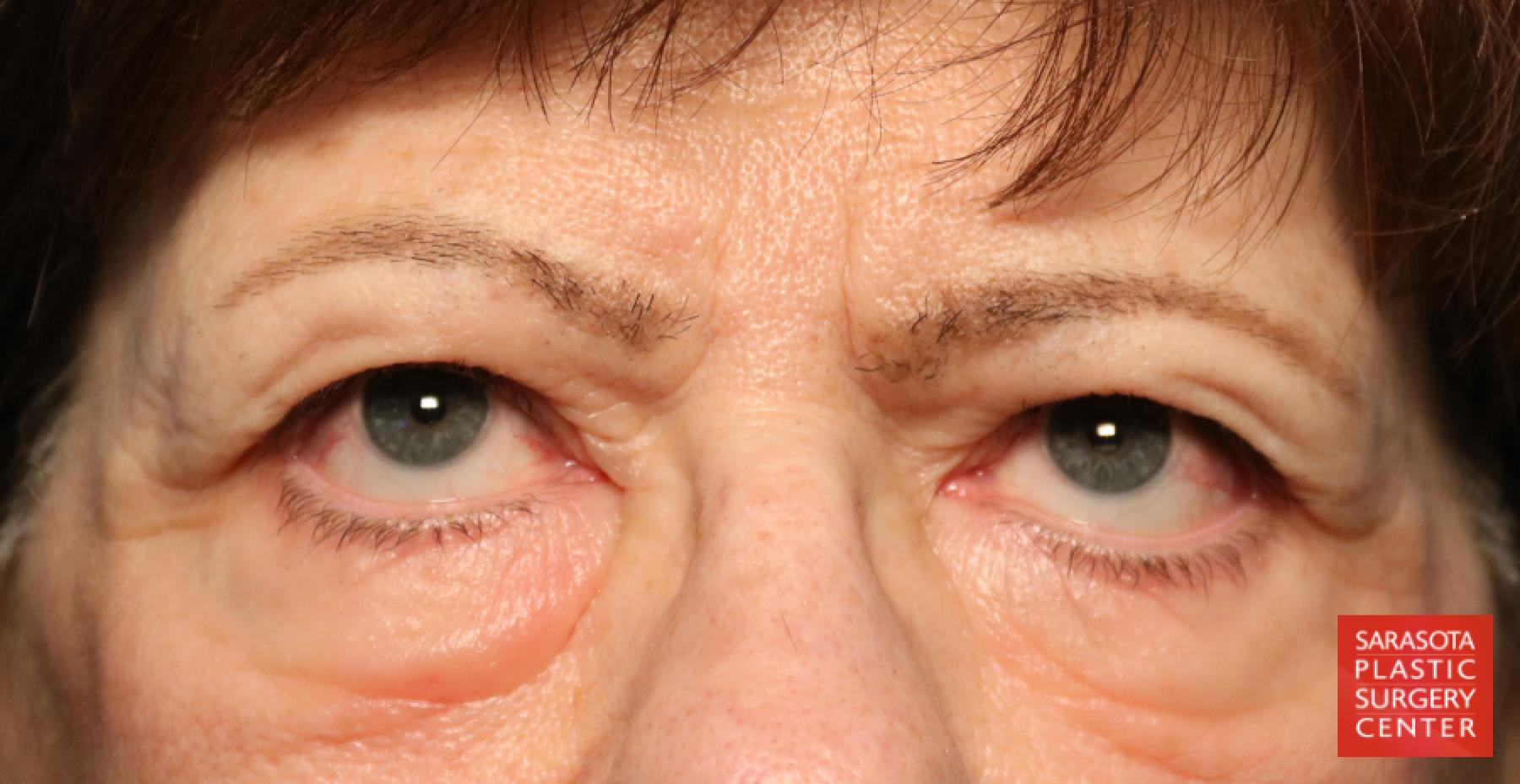 Blepharoplasty: Patient 15 - Before 3