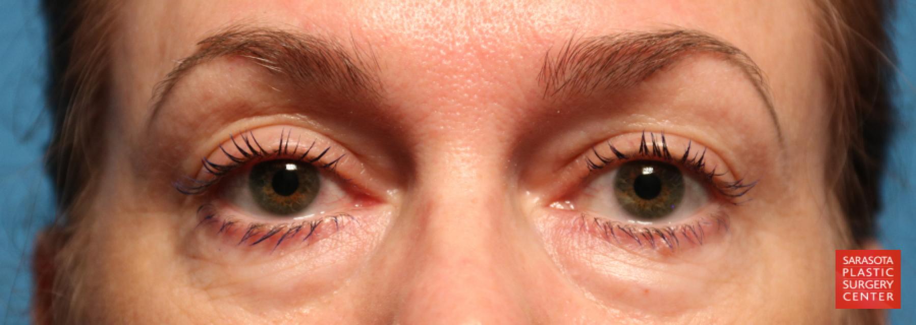 Blepharoplasty: Patient 9 - After  