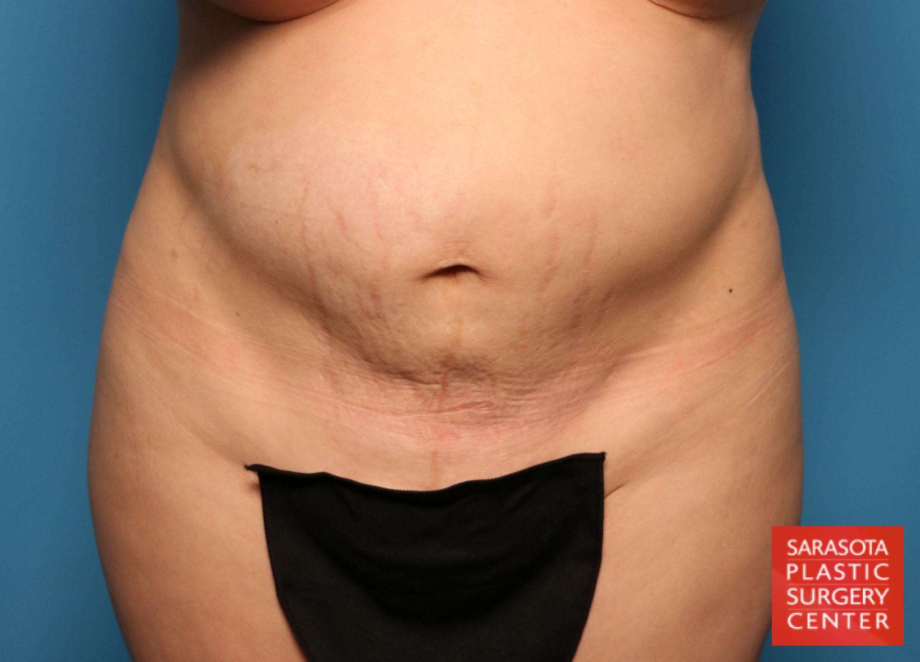 Tummy Tuck: Patient 40 - Before 