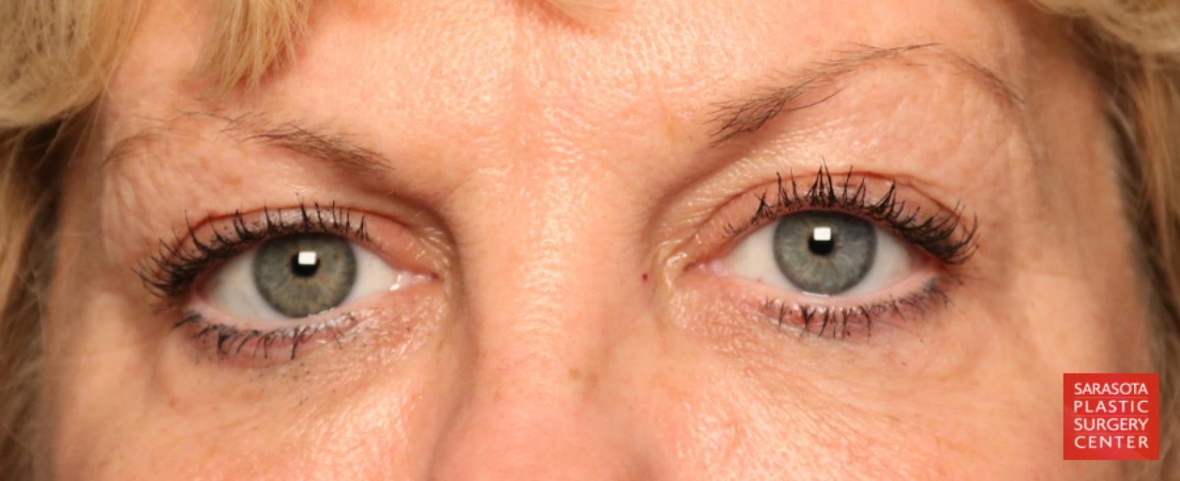 Blepharoplasty: Patient 19 - Before 