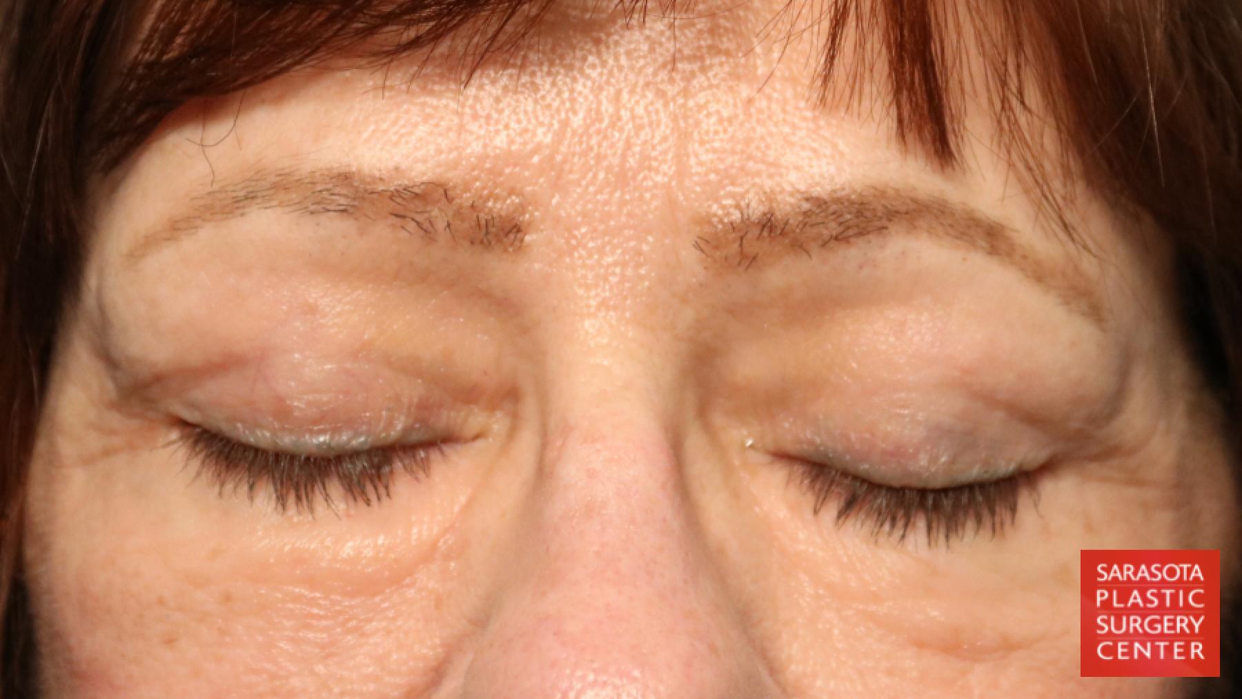 Blepharoplasty: Patient 15 - After 2