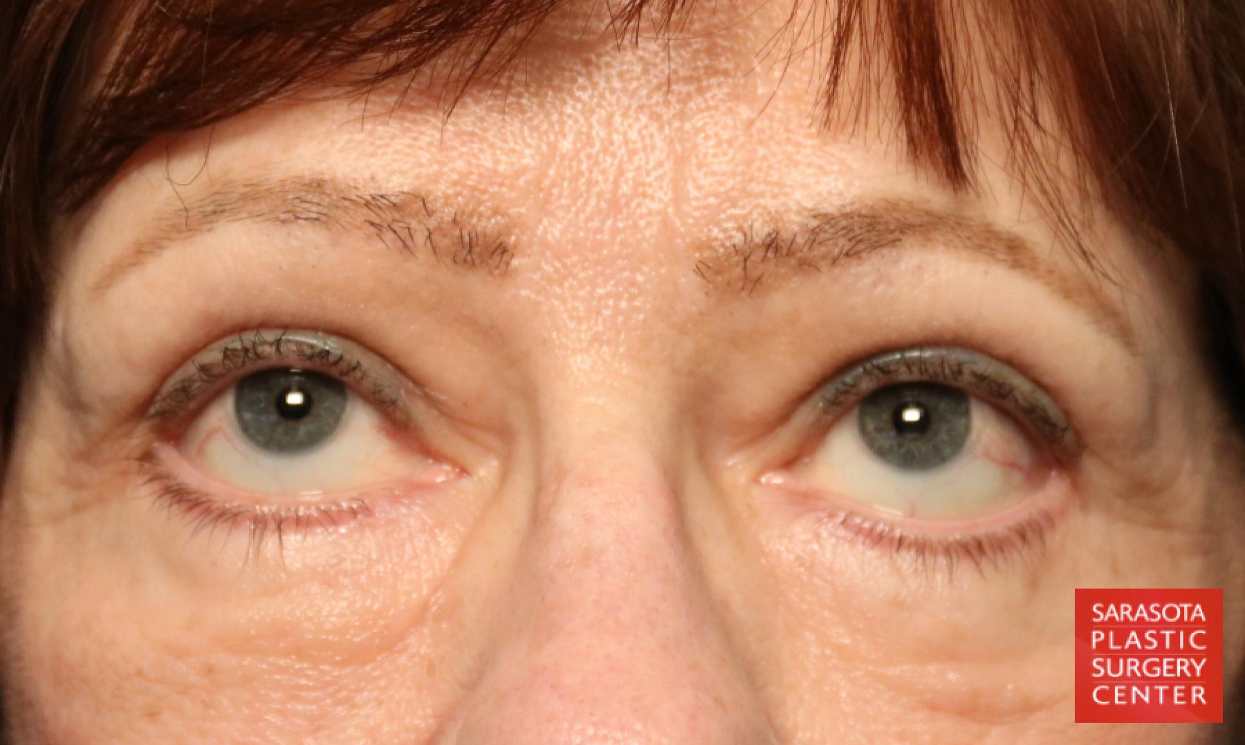 Blepharoplasty: Patient 15 - After 3