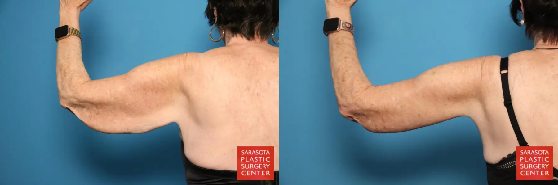Arm Lift: Patient 29 - Before and After 6