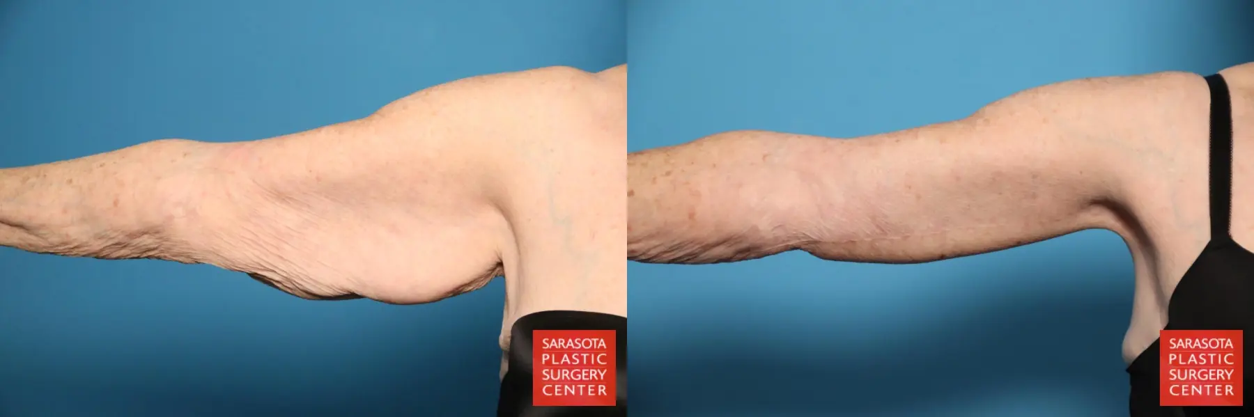 Arm Lift: Patient 29 - Before and After  