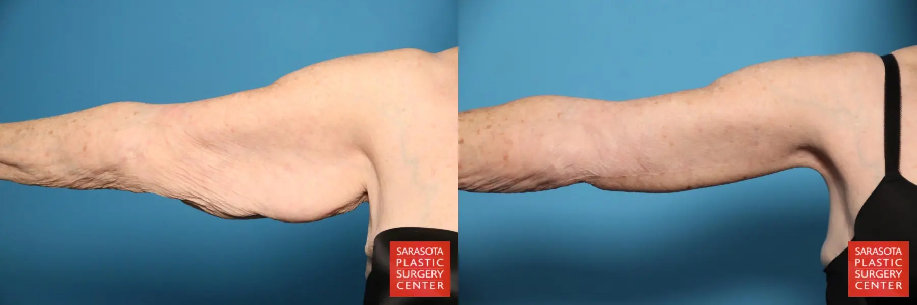 Arm Lift: Patient 29 - Before and After 1