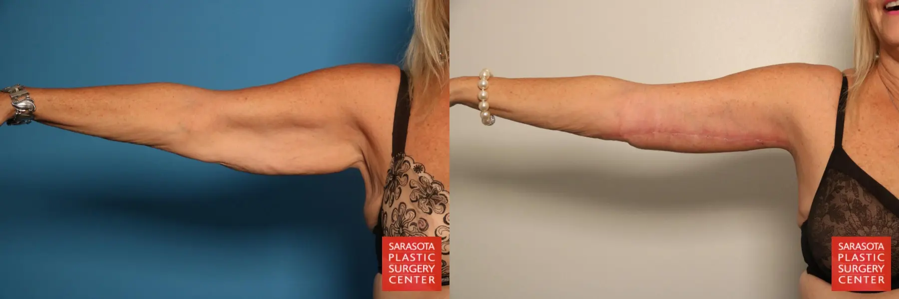 Arm Lift: Patient 8 - Before and After  