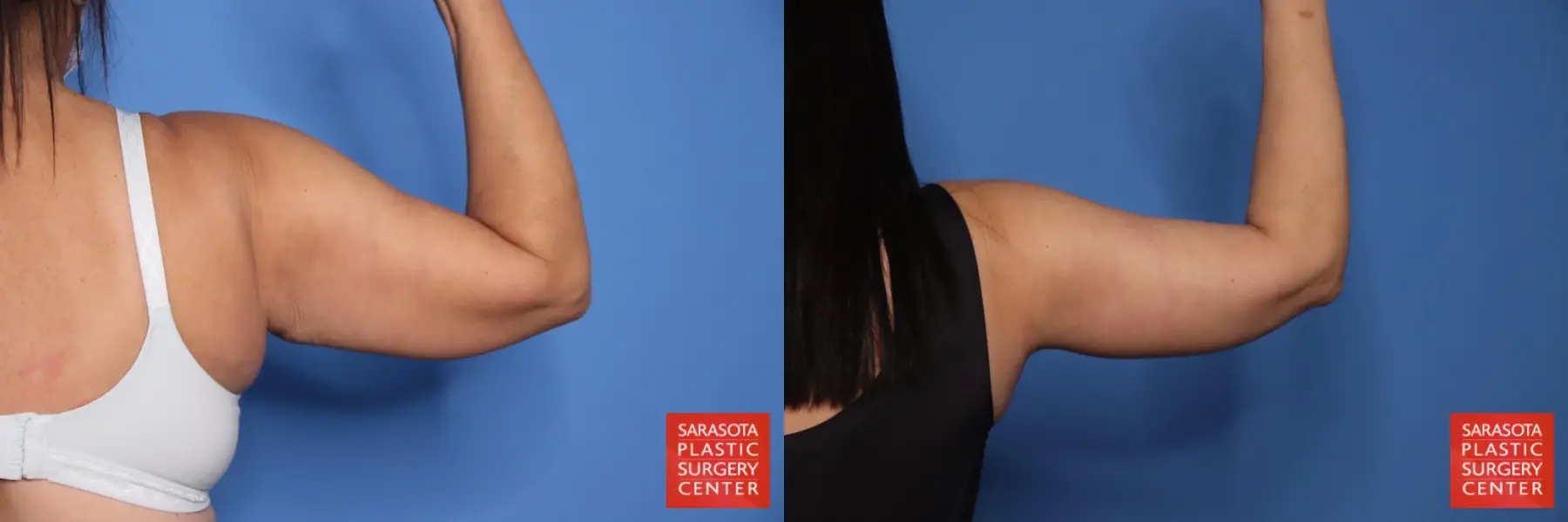 Arm Lift: Patient 35 - Before and After 7