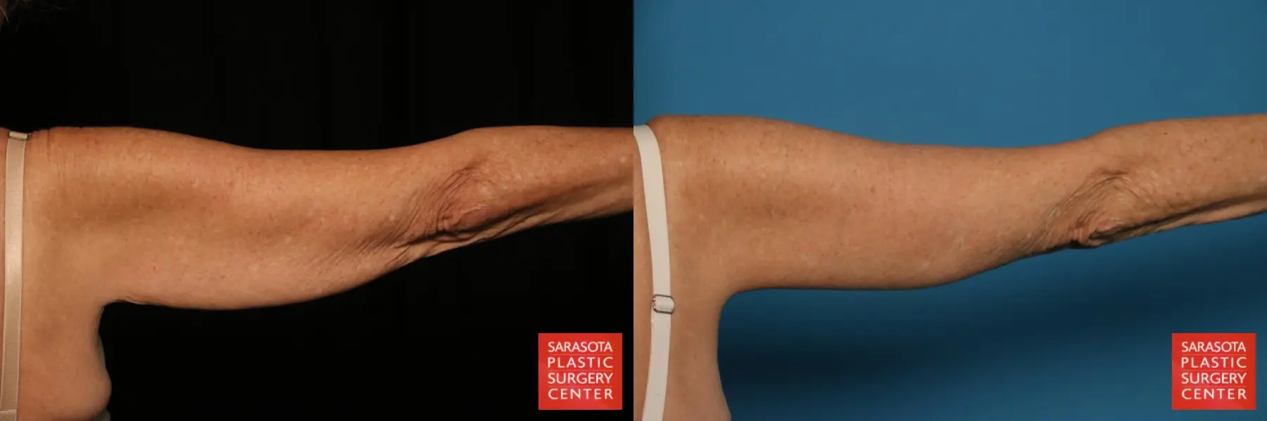 Arm Lift: Patient 10 - Before and After 5