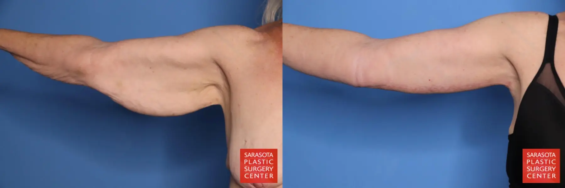 Arm Lift: Patient 33 - Before and After  