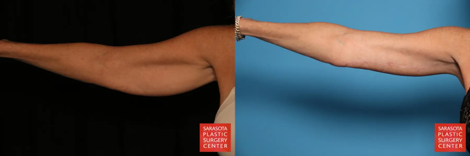 Arm Lift: Patient 32 - Before and After  