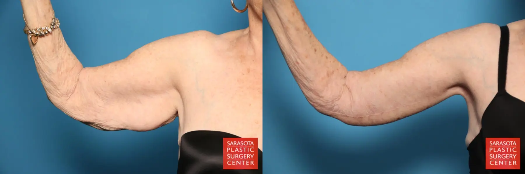 Arm Lift: Patient 29 - Before and After 2
