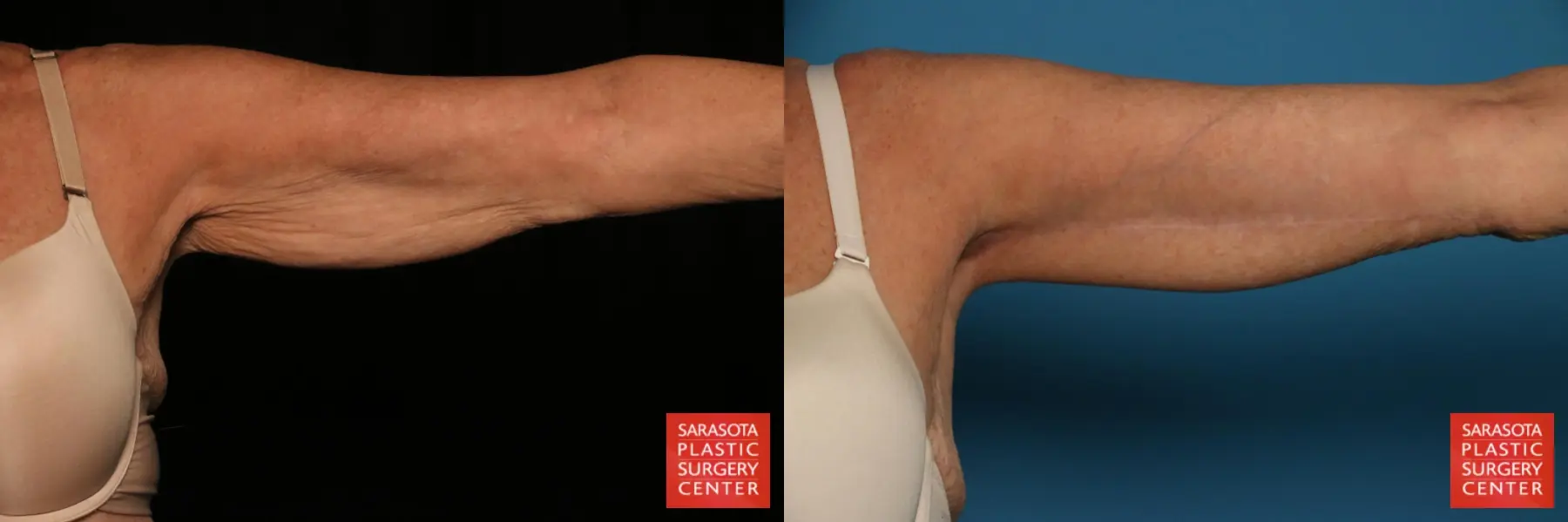 Arm Lift: Patient 10 - Before and After  