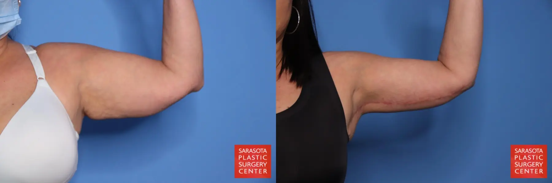 Arm Lift: Patient 35 - Before and After  