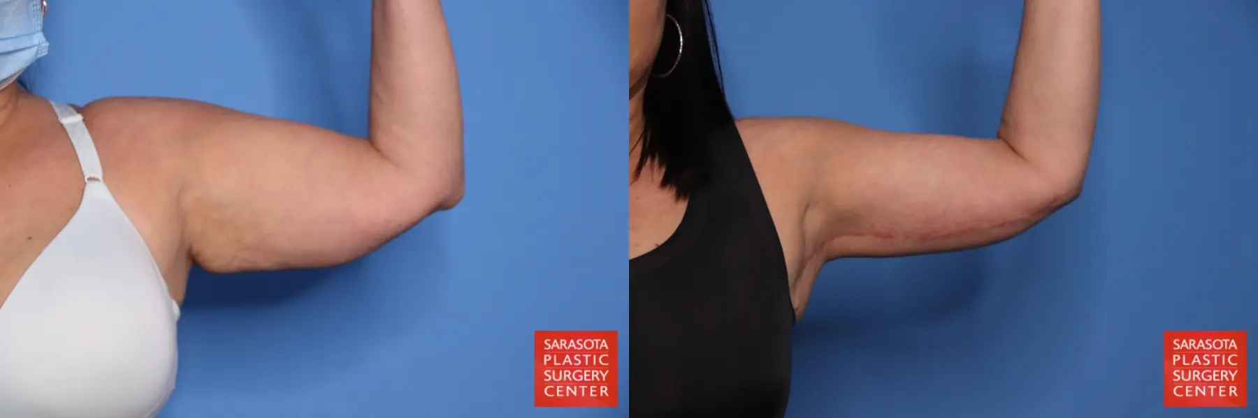 Arm Lift: Patient 35 - Before and After 1