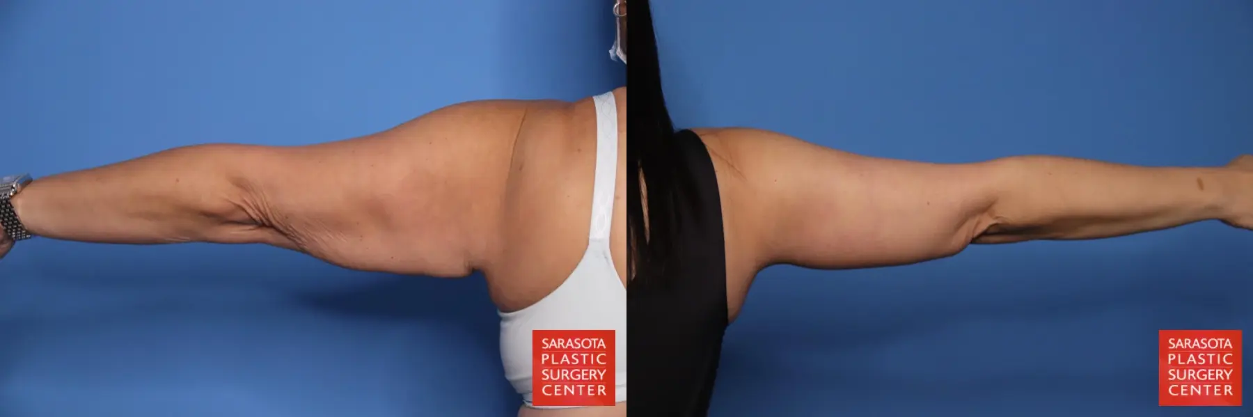 Arm Lift: Patient 35 - Before and After 6