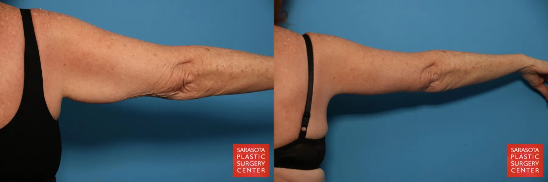 Arm Lift: Patient 6 - Before and After 5