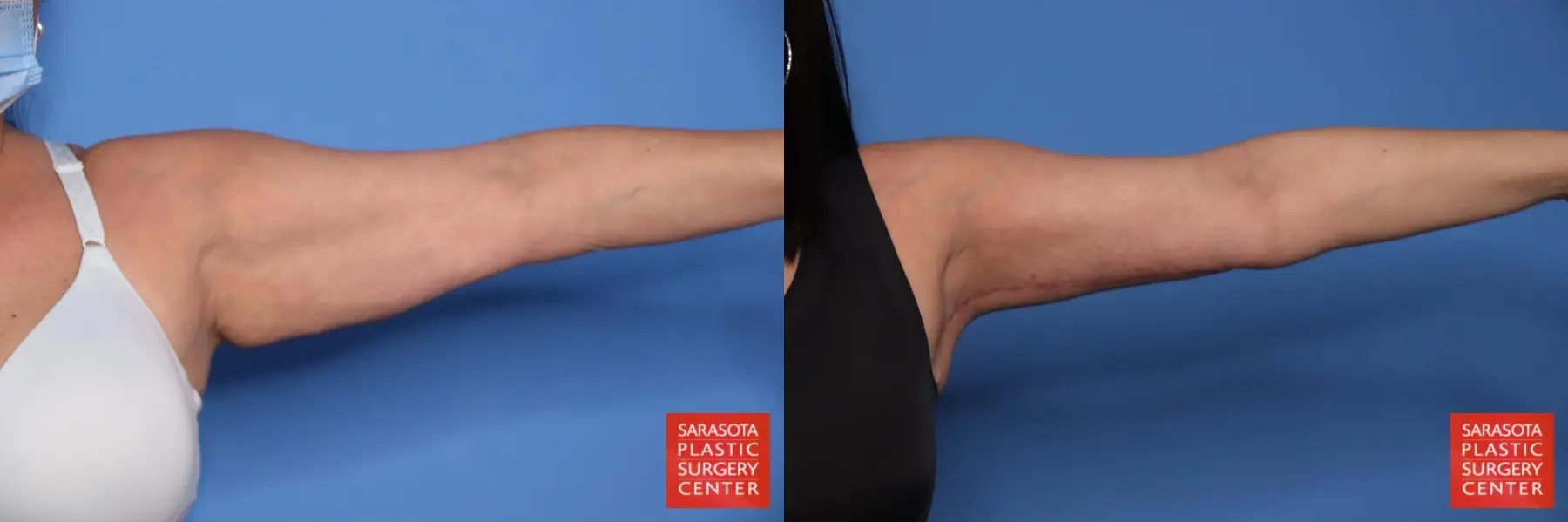 Arm Lift: Patient 35 - Before and After 2
