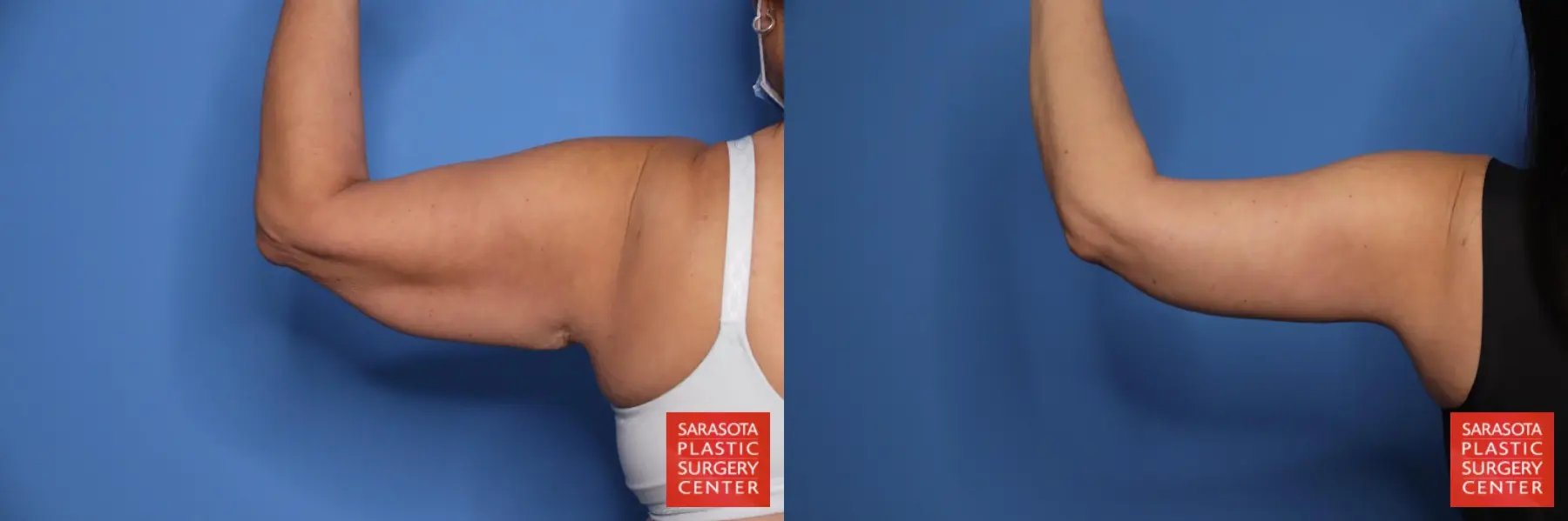 Arm Lift: Patient 35 - Before and After 5