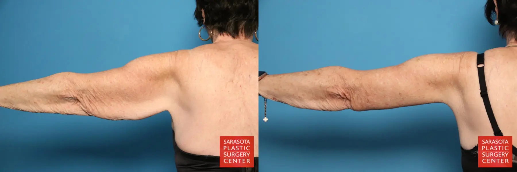 Arm Lift: Patient 29 - Before and After 5