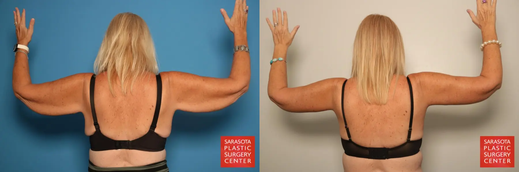 Arm Lift: Patient 8 - Before and After 6