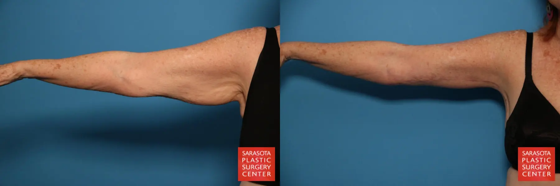 Arm Lift: Patient 6 - Before and After 1
