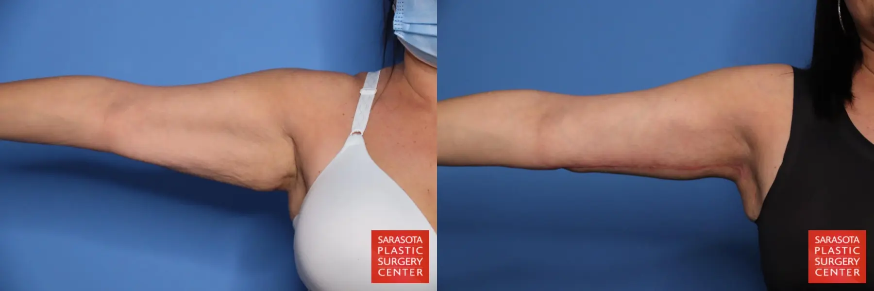Arm Lift: Patient 35 - Before and After 4
