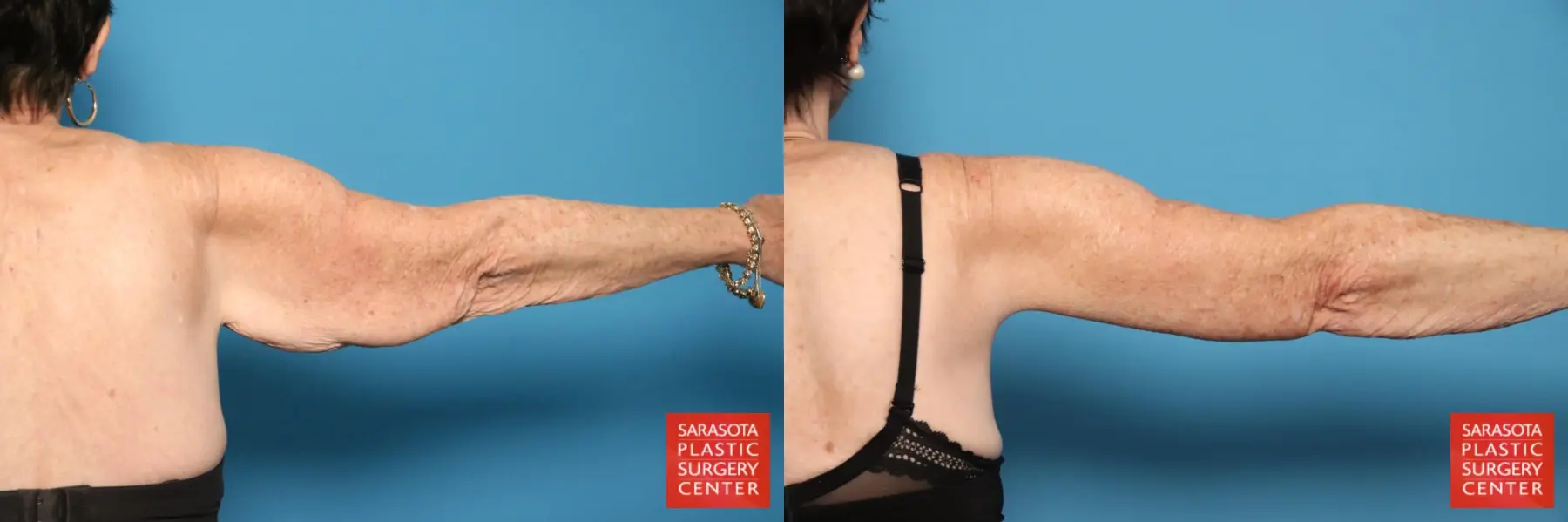 Arm Lift: Patient 29 - Before and After 7