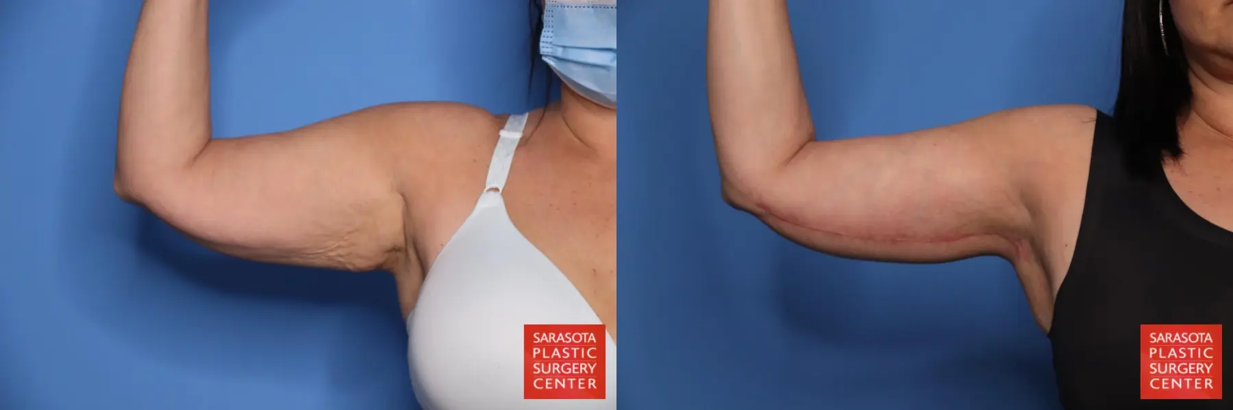 Arm Lift: Patient 35 - Before and After 3