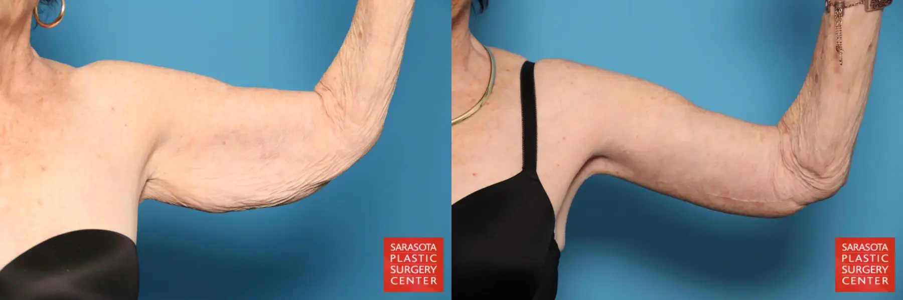 Arm Lift: Patient 29 - Before and After 4