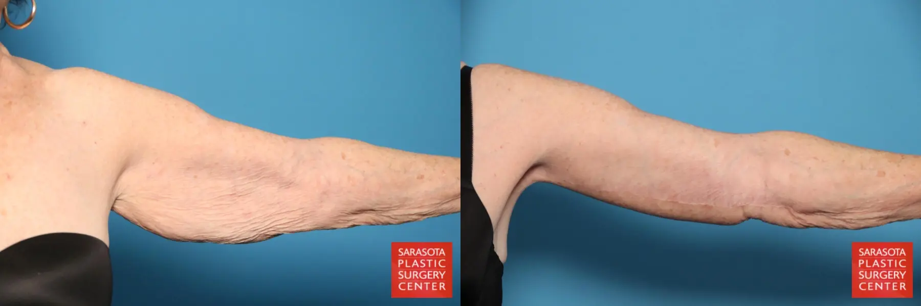 Arm Lift: Patient 29 - Before and After 3