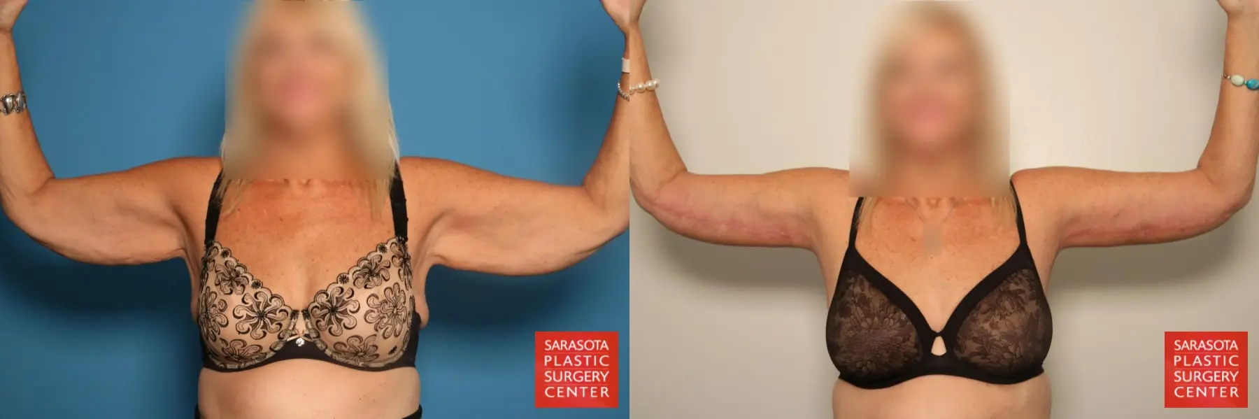 Arm Lift: Patient 8 - Before and After 5