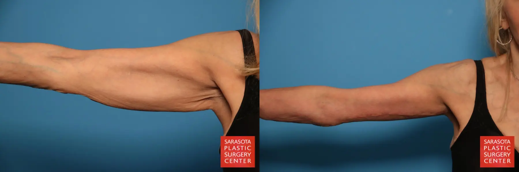 Arm Lift: Patient 2 - Before and After  