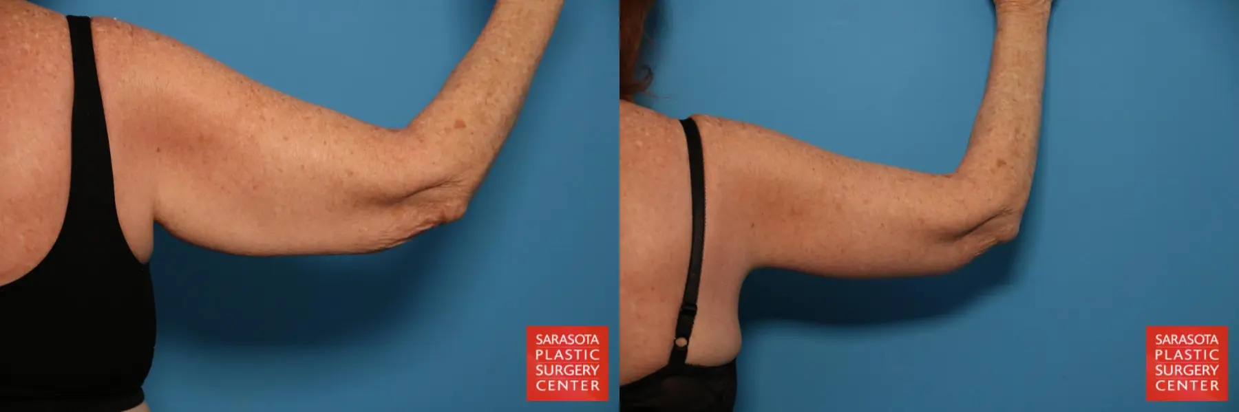 Arm Lift: Patient 6 - Before and After 6