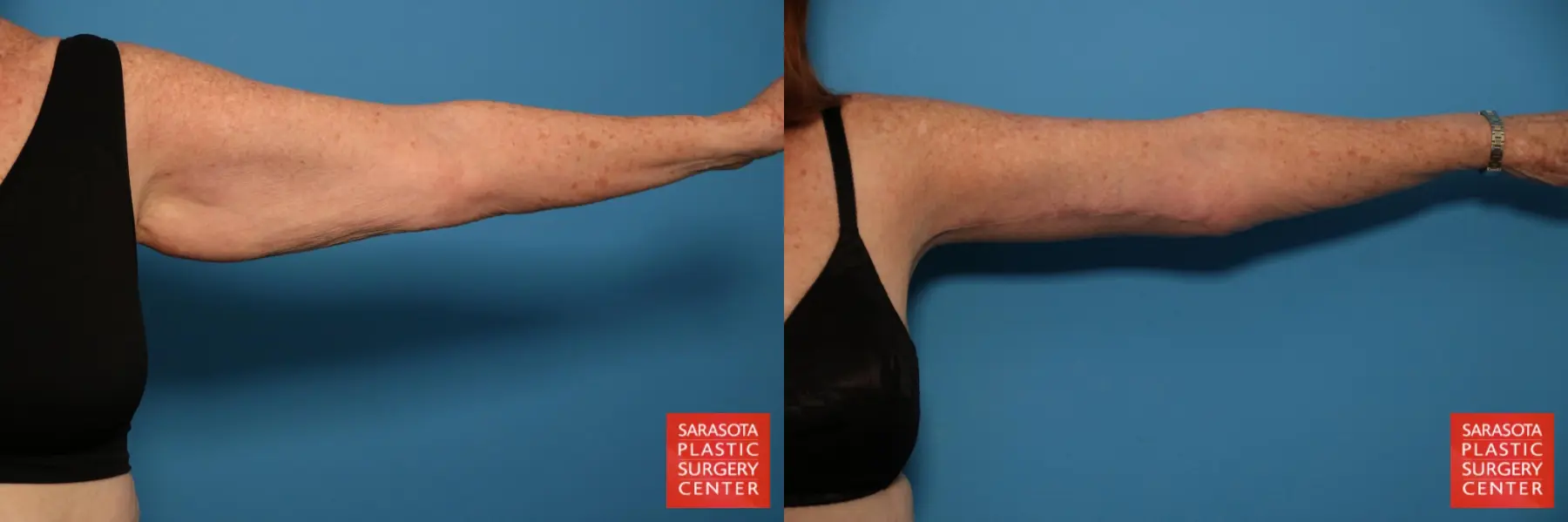 Arm Lift: Patient 6 - Before and After 3