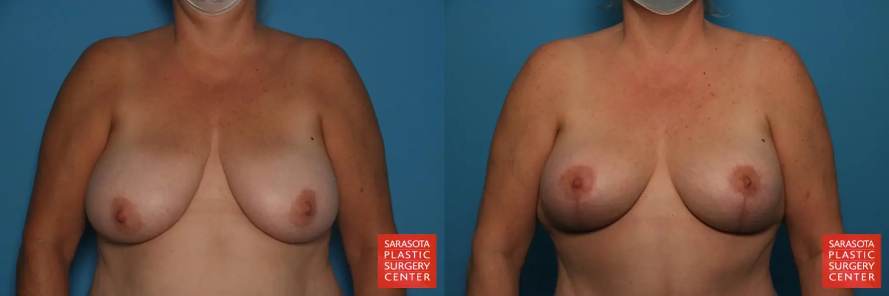 Auto-Augmentation: Patient 9 - Before and After  