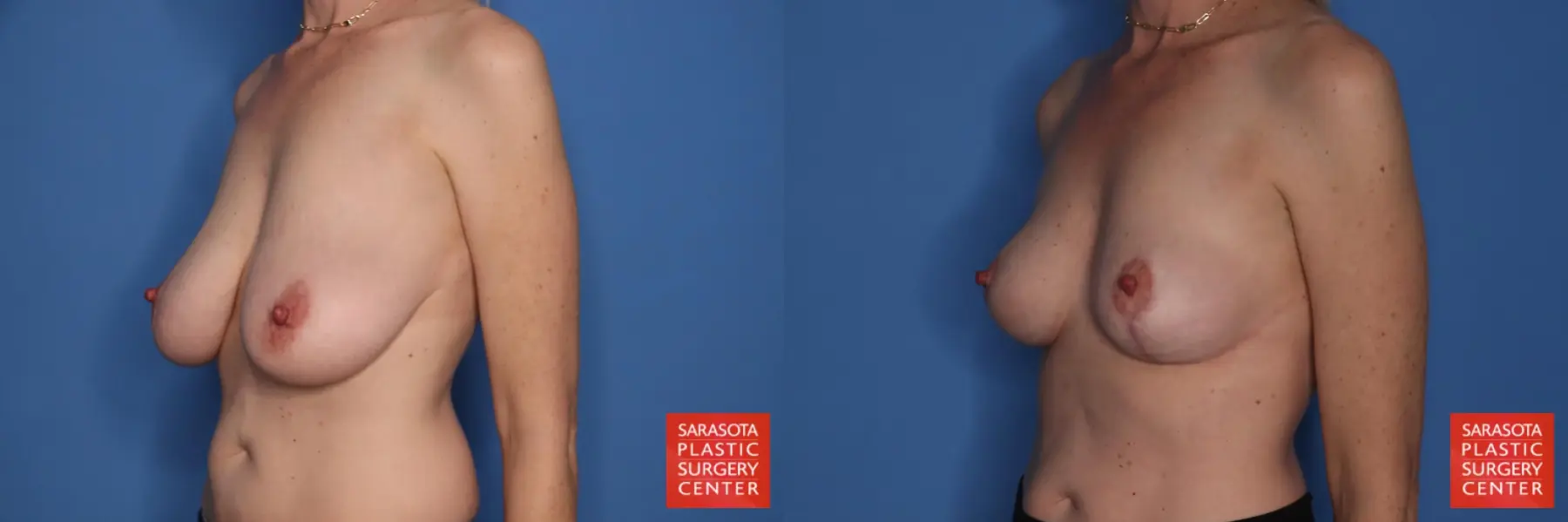 Auto-Augmentation: Patient 6 - Before and After 2