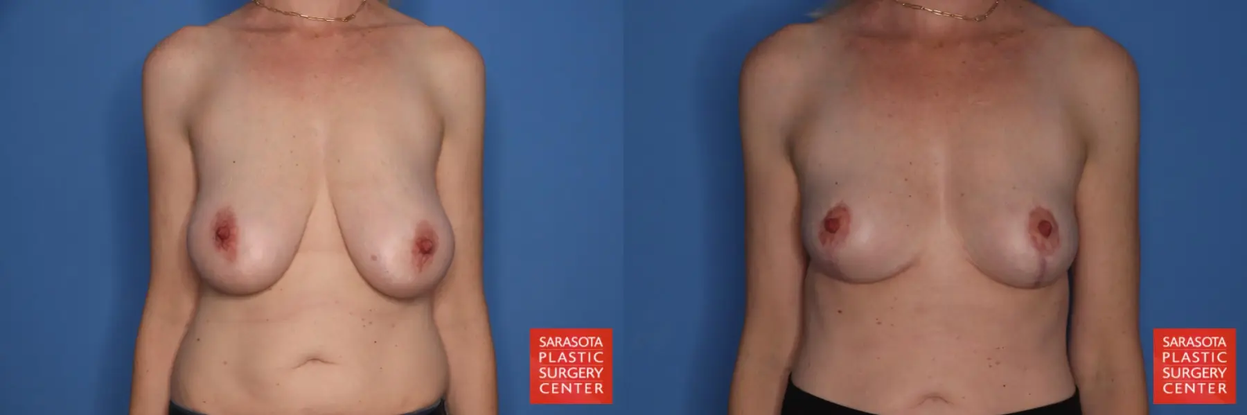 Auto-Augmentation: Patient 6 - Before and After 1