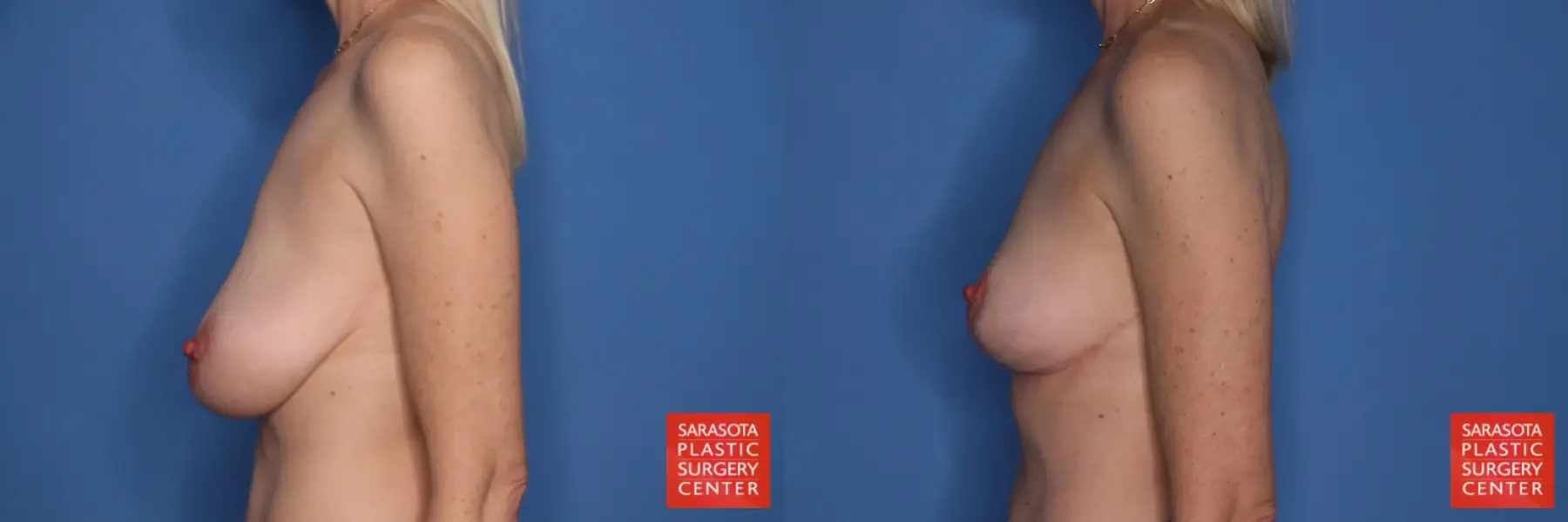 Auto-Augmentation: Patient 6 - Before and After 3