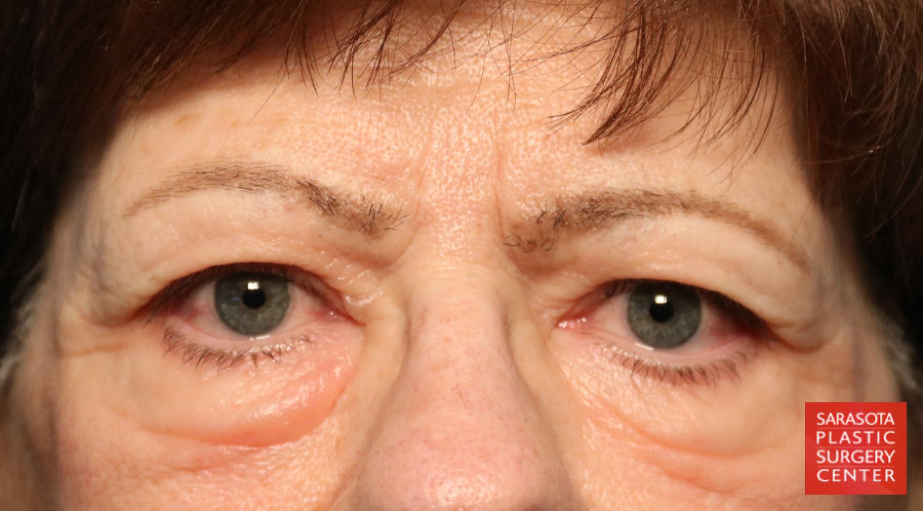 Blepharoplasty: Patient 15 - Before 