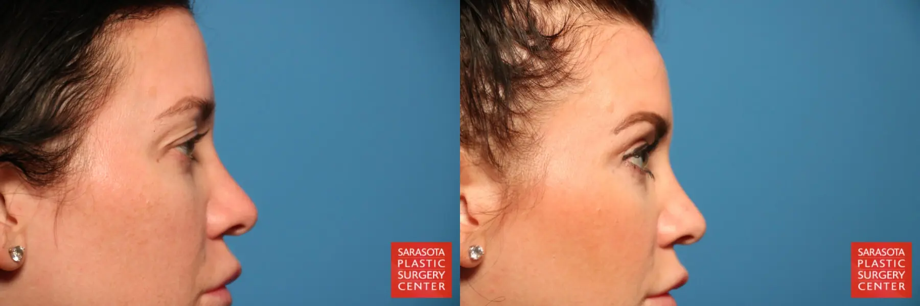 Blepharoplasty: Patient 11 - Before and After 7