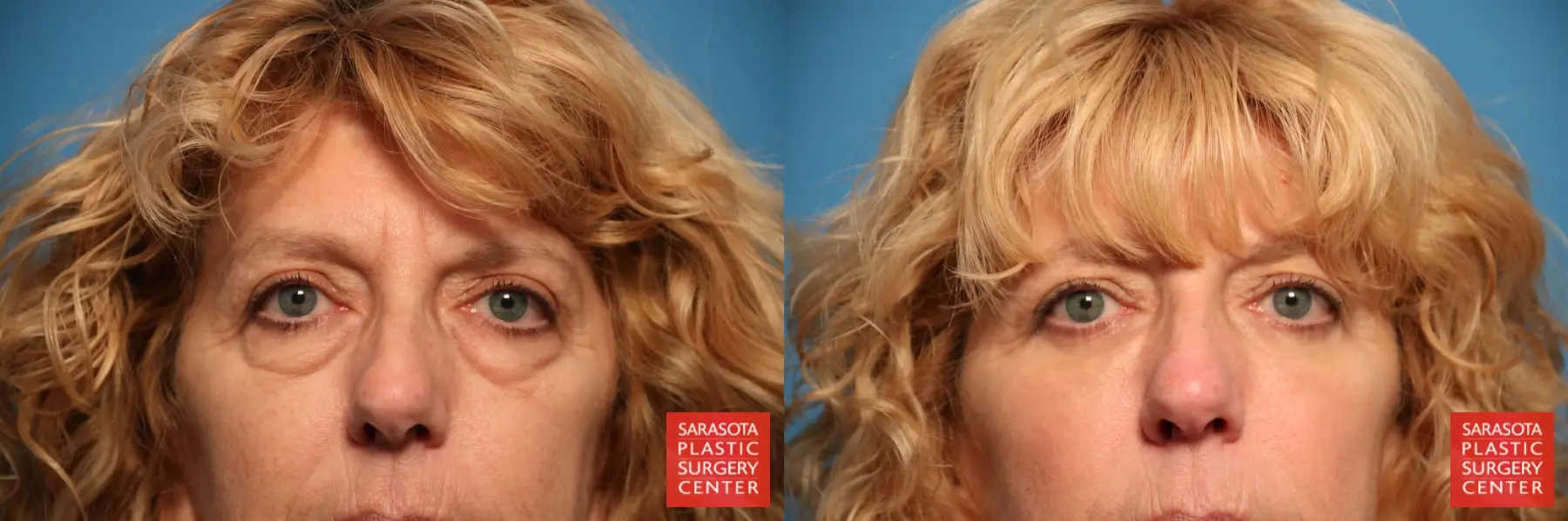 Blepharoplasty: Patient 5 - Before and After  