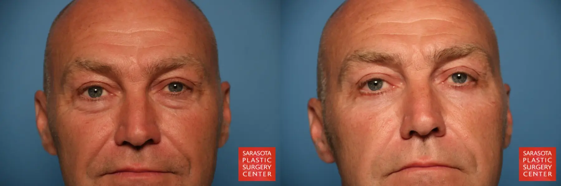 Blepharoplasty: Patient 13 - Before and After  