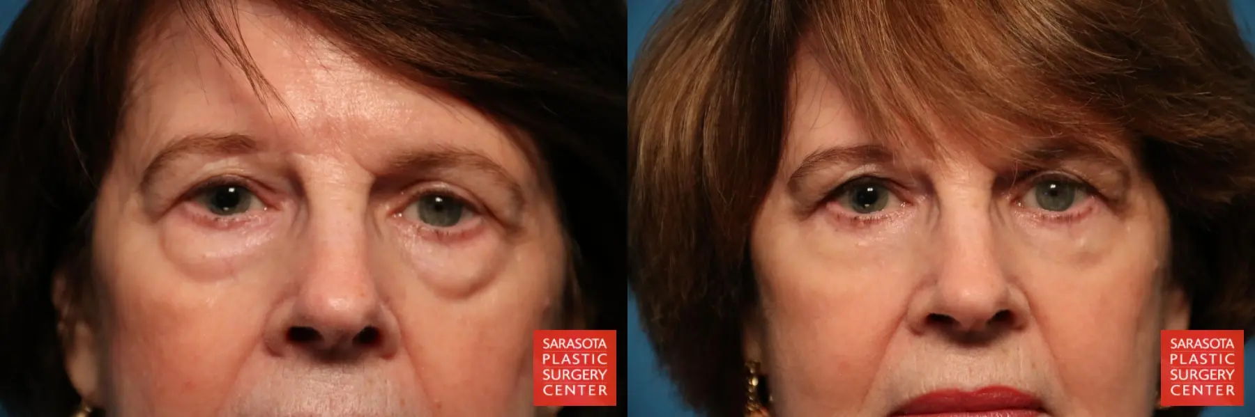 Blepharoplasty: Patient 5 - Before and After  